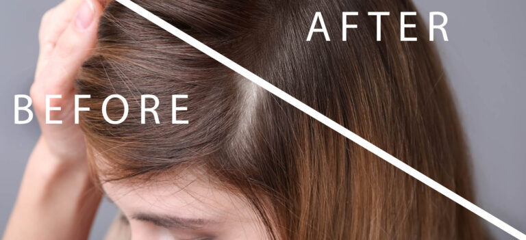 kobieta przed po leczenie trychologiczne efekty