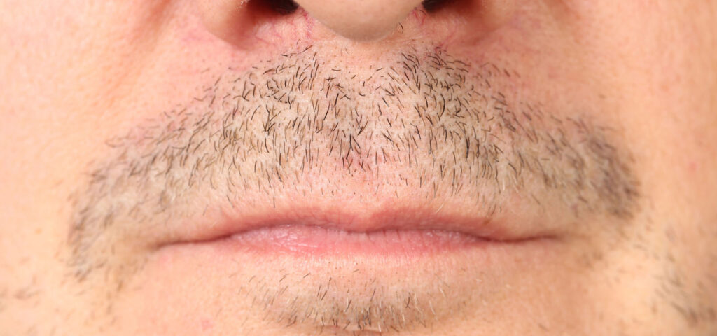 Zbliżenie na twarz mężczyzny z rzadkim zarostem na górnej wardze i policzkach, ukazujące nieregularny wzrost włosów na twarzy.