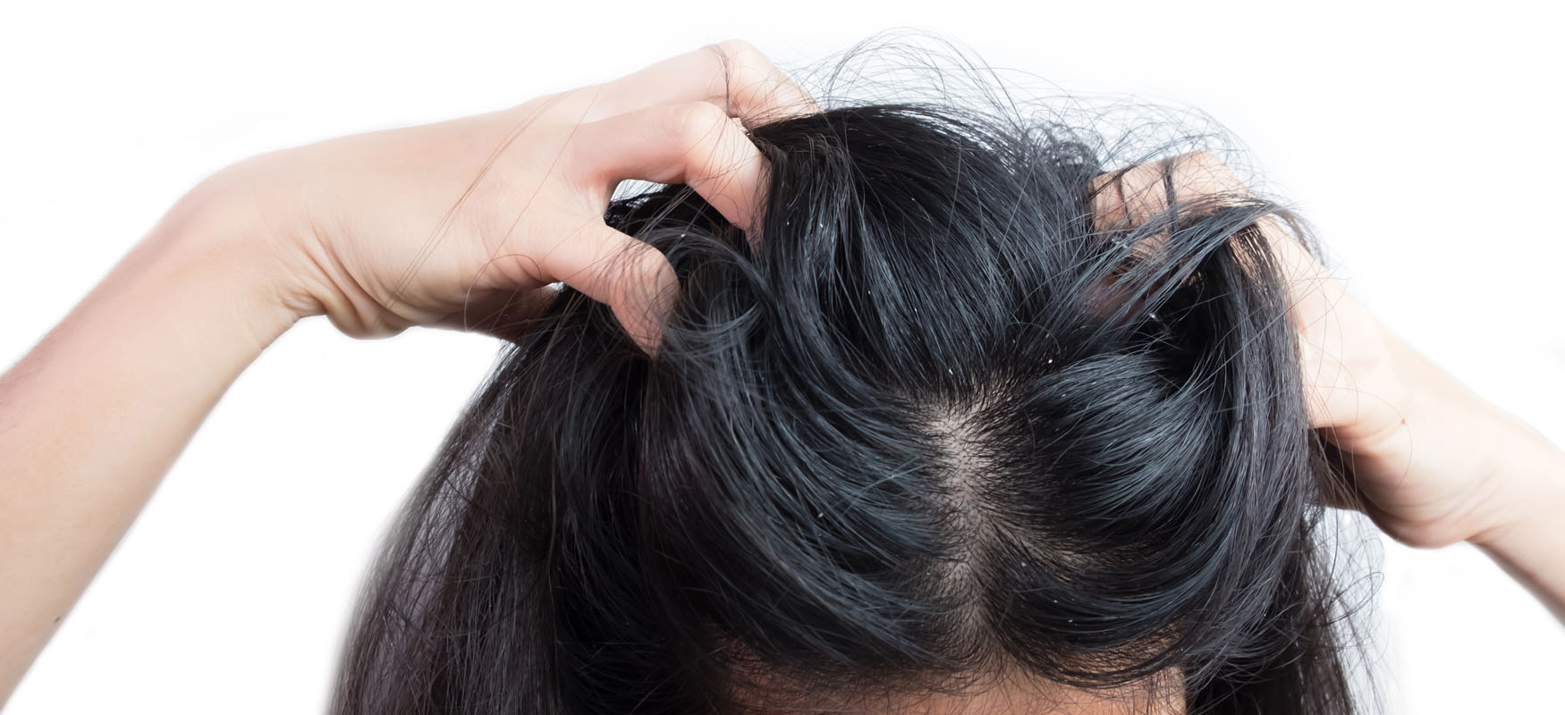 Łupież tłusty – jak wygląda i jak się go pozbyć?