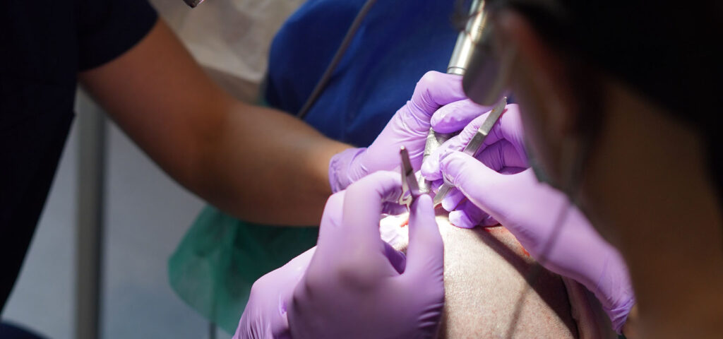 narzedzia podczas przeszczepu wlosow