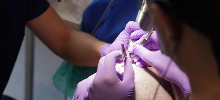 narzedzia podczas przeszczepu wlosow