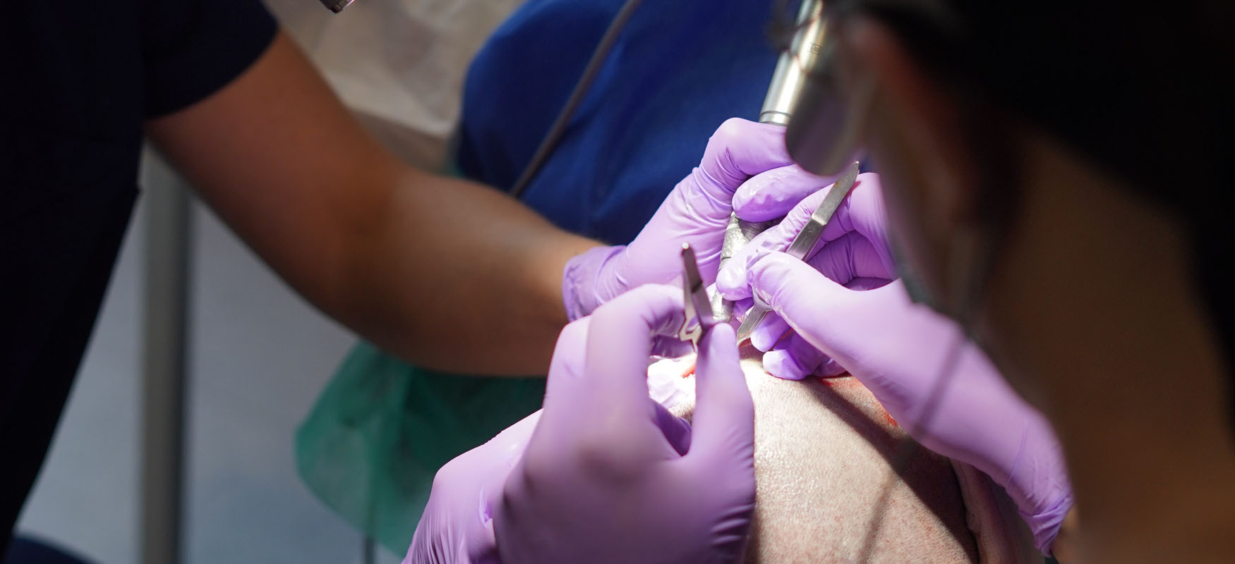 Jakie narzędzia są używane do przeszczepu włosów?