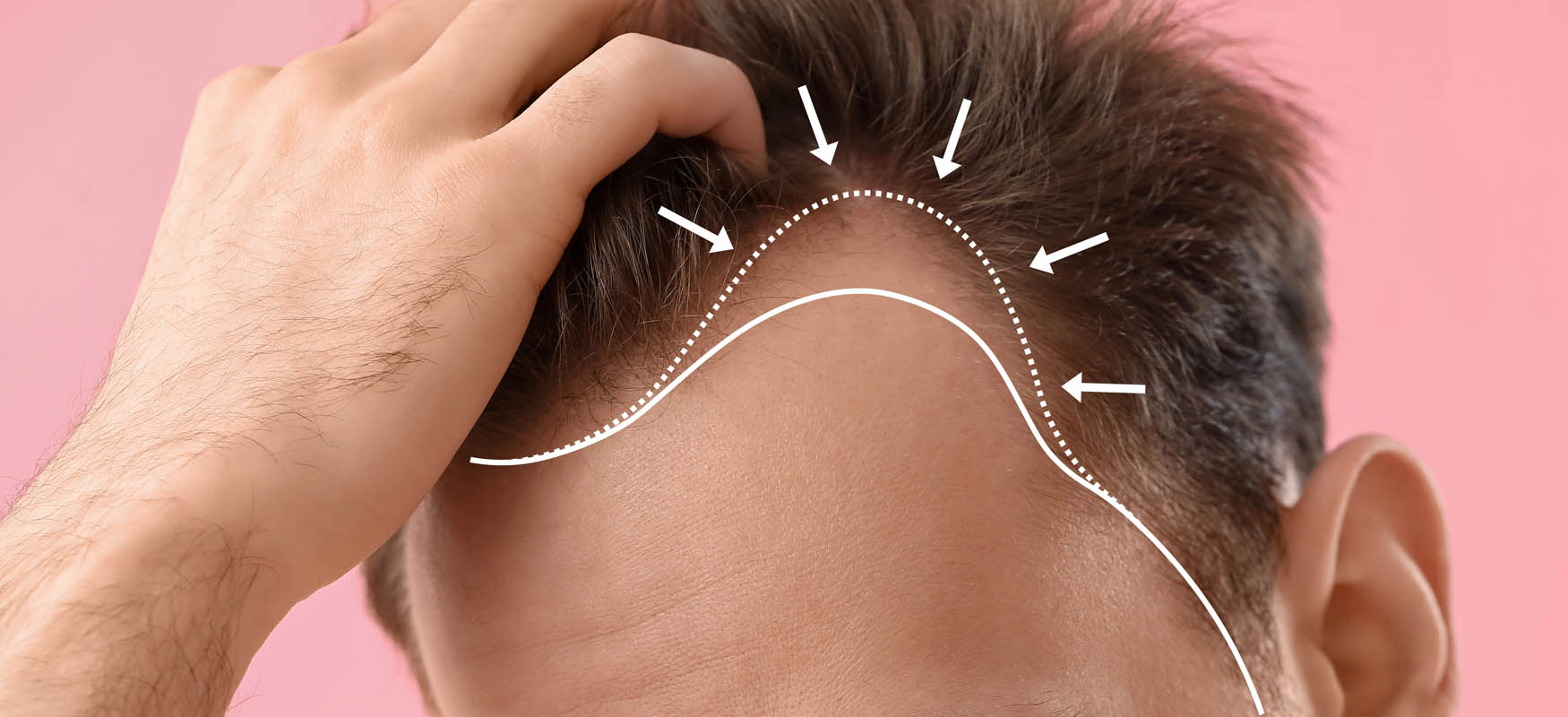 Czy można powtórzyć przeszczep włosów? Kiedy i jak to zrobić