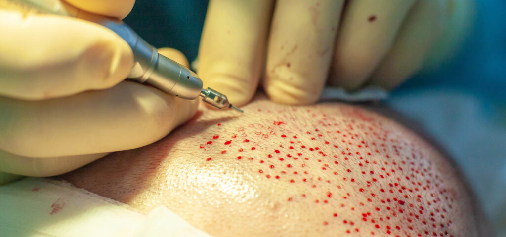 pobieranie graftow pobieranie graftow