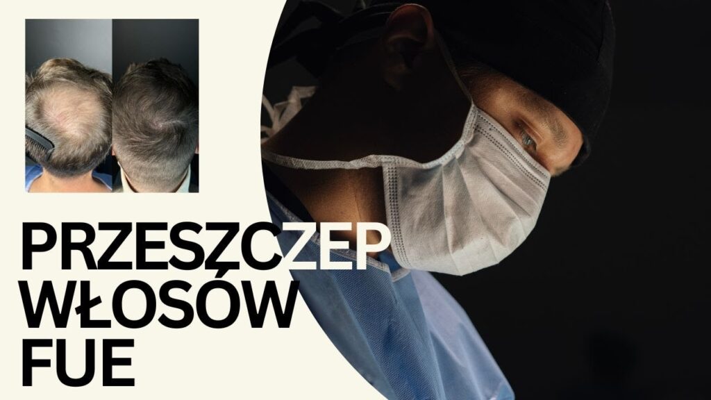Przeszczep włosów metodą FUE – co trzeba wiedzieć