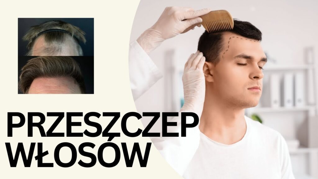 Przeszczep włosów – czy może się nie przyjąć?