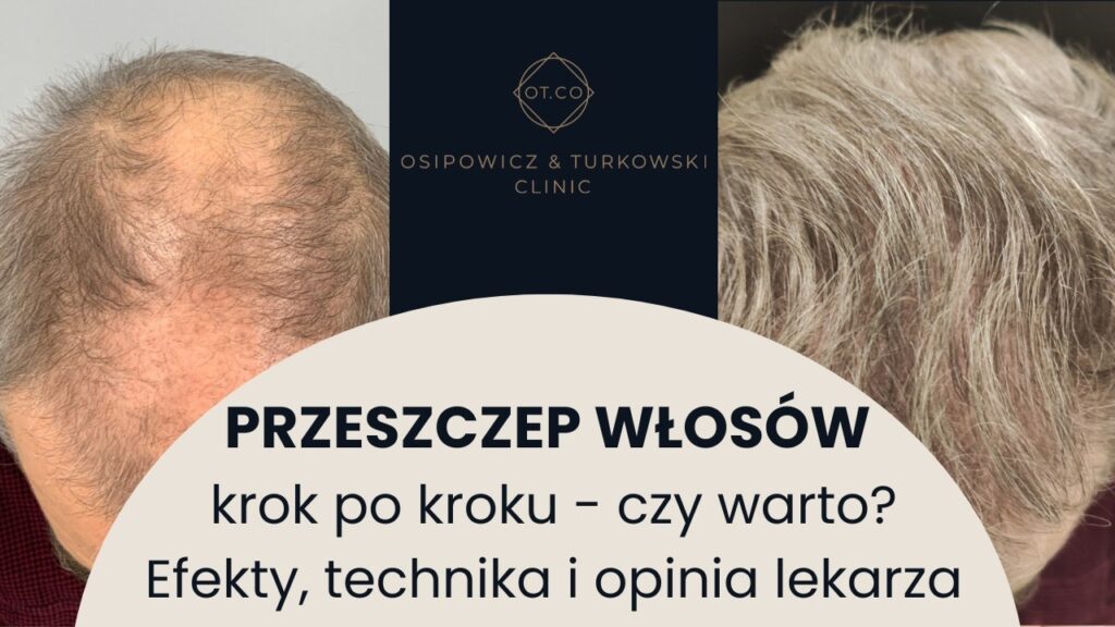Przeszczep włosów – cała prawda, czy boli, jakie daje efekty