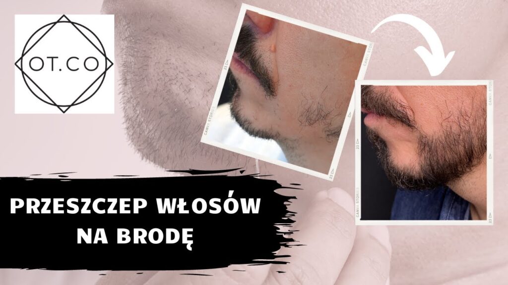 Przeszczep brody – efekt przed i po zabiegu